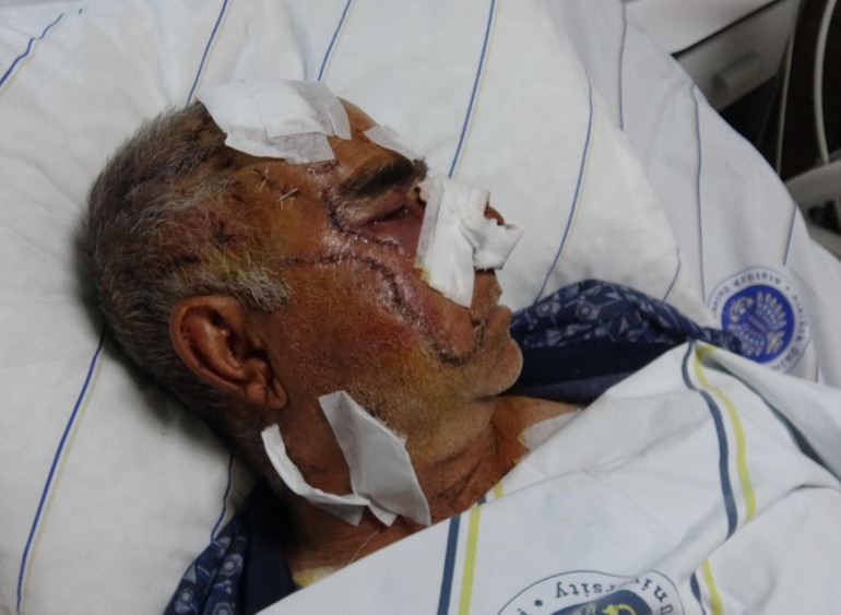 Vahşi hayvan saldırısı sonrası yüz onarımı