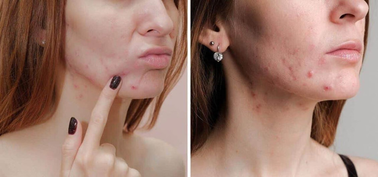 Retinol gerçekten işe yarıyor mu