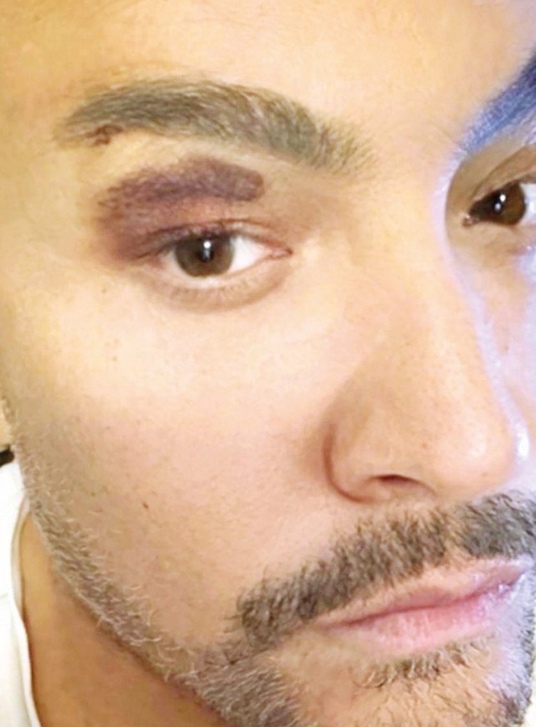 Cenk Eren sahne kazası geçirdi