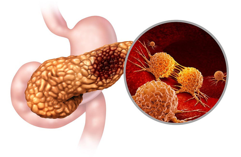 Mikrobiyota haritasında yeni bir sayfa açıldı, pankreas mikrobiyotası keşfedildi Kanserle savaşta yeni umut olacak