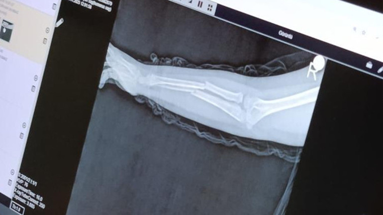  9 yaşındaki çocuk arkadaşının kolunu iki yerinden kırdı Öğretmene şikayet ettiği için intikamını aldım