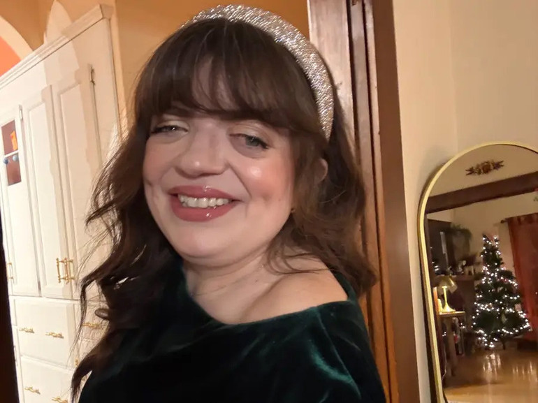 Nadir bir genetik durumla doğdu, doktorlarını bile şaşırttı... Yıllarca meraklı bakışlara maruz kaldı Nasıl başardığını anlattı