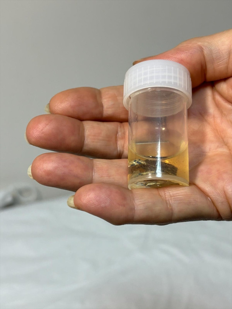 Antalyada ilginç olay Hapı alüminyum kabıyla yuttu, 4 yıl sonra akciğerinden bütün halinde çıkarıldı... Meğer hapı yutmuşum