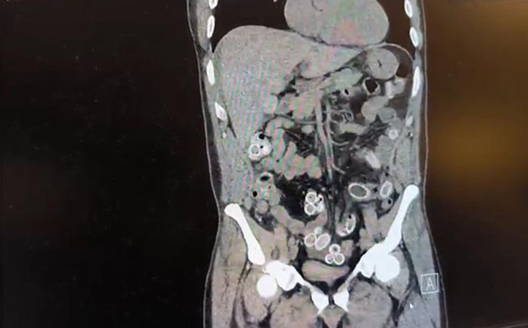 Fastan Türkiyeye midesinde getirdi Ameliyatla çıkarıldıktan sonra tutuklandı