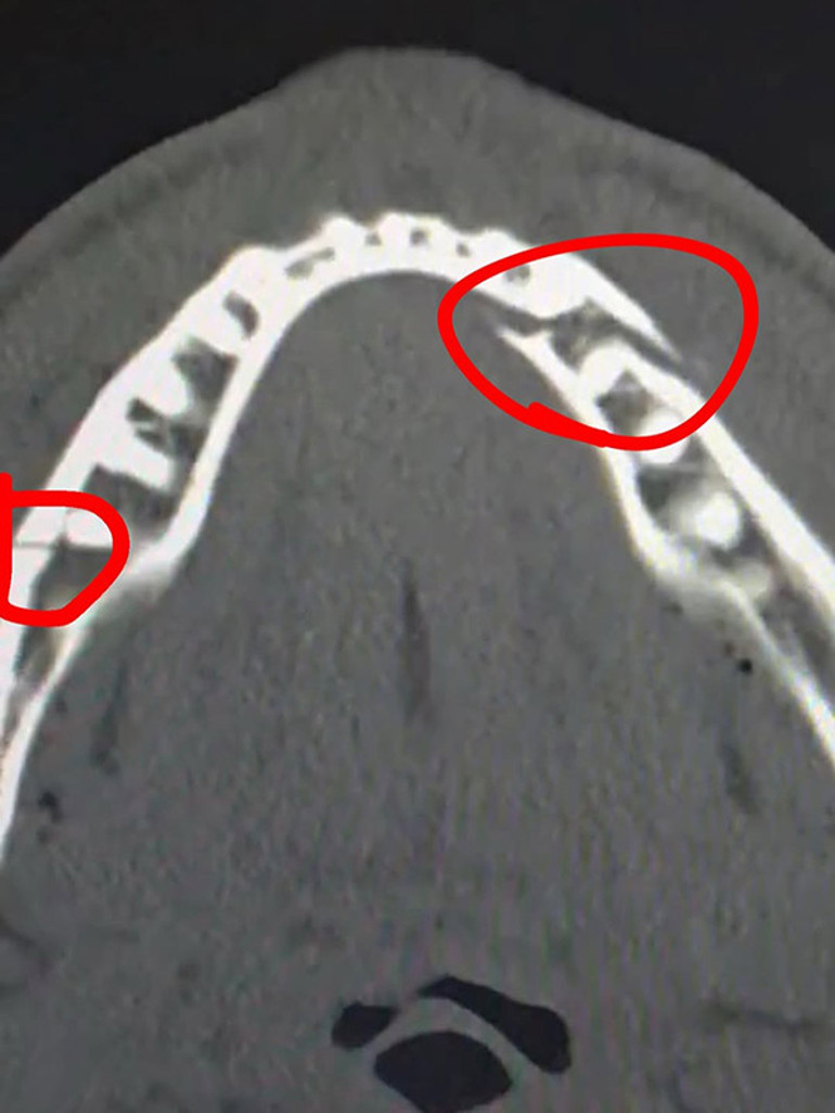 Çenesi kırılan Jake Pauldan açıklama 7 gün boyunca sıvı tüketmem gerekiyor