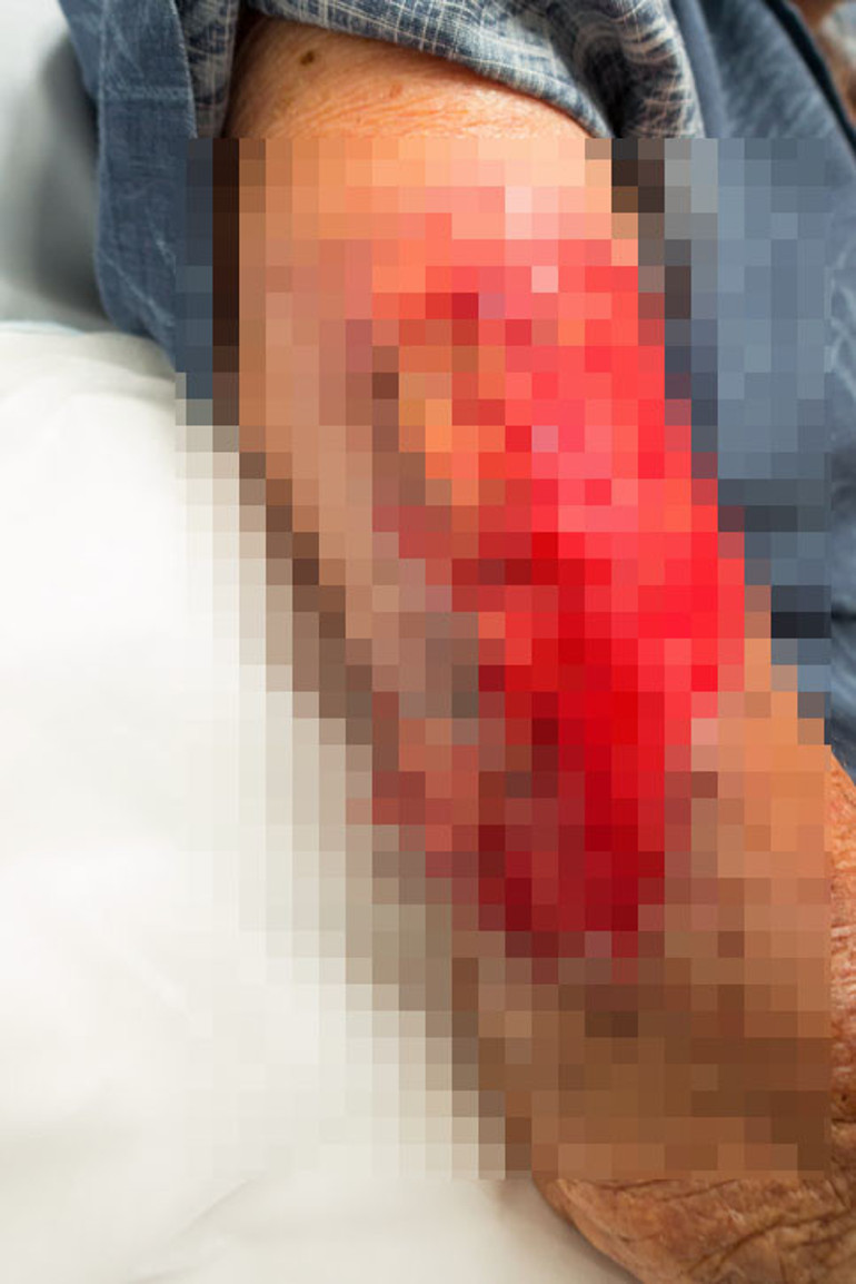 Basit bir boğaz ağrısı kâbusu başlattı: ‘Hayatta olmam bir mucize’ | 25 ameliyat geçirdi... Bu belirtilere dikkat