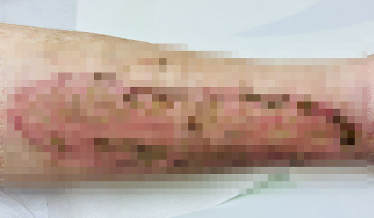 Basit bir boğaz ağrısı kâbusu başlattı: ‘Hayatta olmam bir mucize’ | 25 ameliyat geçirdi... Bu belirtilere dikkat