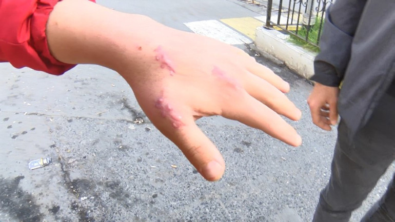  Parmağım düştü deyip doktora dava açtı