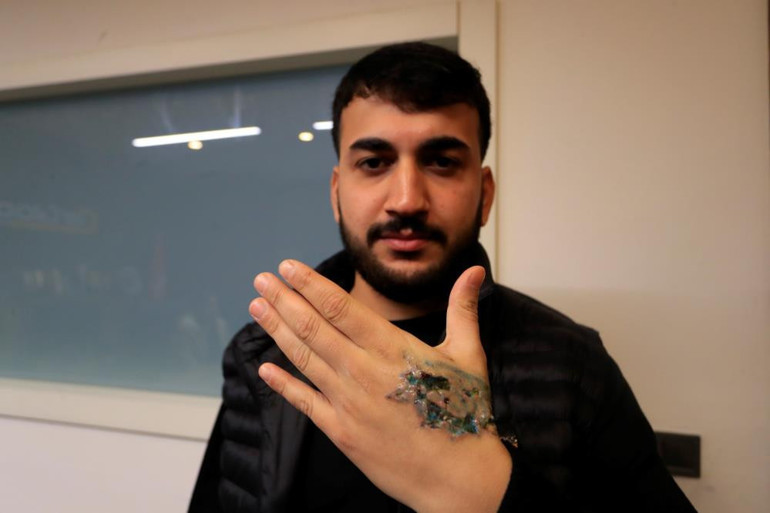 Dövme sildirmek isteyen genç kabusu yaşadı, elindeki dokular öldü