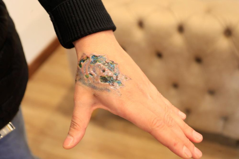 Dövme sildirmek isteyen genç kabusu yaşadı, elindeki dokular öldü