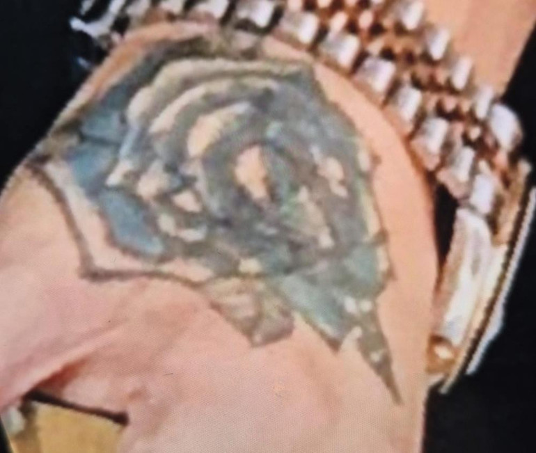 Dövme sildirmek isteyen genç kabusu yaşadı, elindeki dokular öldü