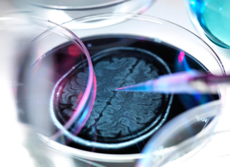 Demansı yaşlılık hastalığı olarak bilirdik… 24 yaşındaki genci nasıl hayattan kopardı