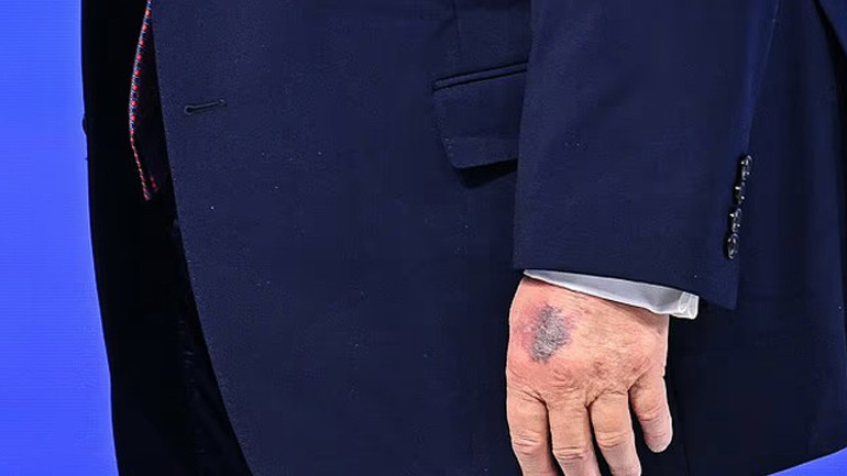 Trump elindeki morluğun sebebini açıkladı