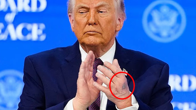 Trump elindeki morluğun sebebini açıkladı