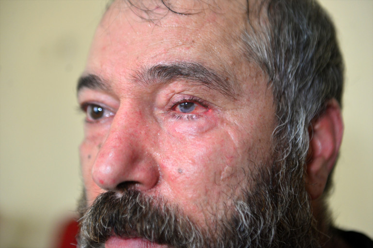 Adanada dolmuş durağında çay bardaklı dehşet Küfürlü konuşmayın diye uyardı, gözünü kaybetti