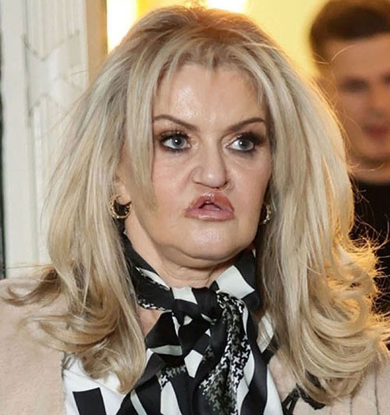 O bebeksi görüntüsü hatıralarda kaldı... Güzelleşme hırsı ünlü oyuncunun yüzünü de parasını da aldı götürdü