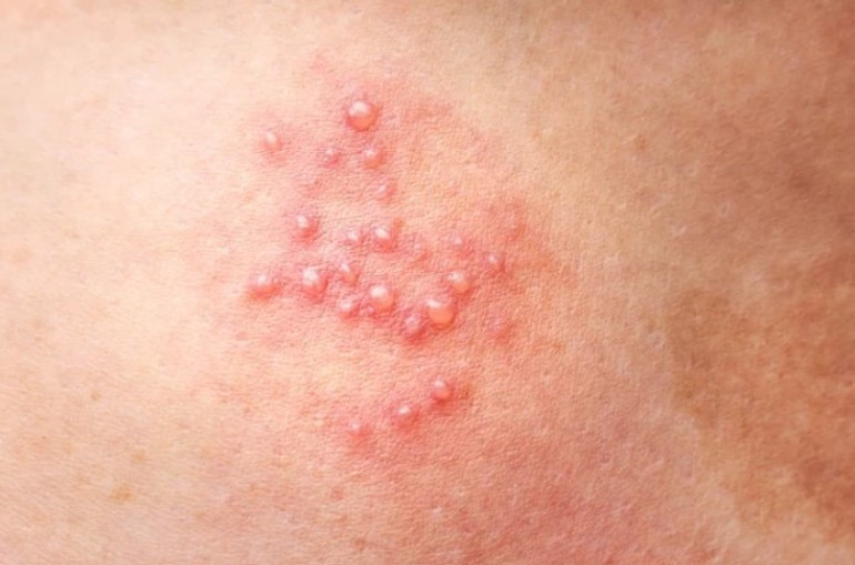  Ölümcül olabiliyor ‘Derime kaynar su dökülmüş gibiydi’, ‘Eve kapandım, dışarı çıkamadım’