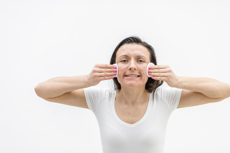 Yetişkin aknesi neden artıyor