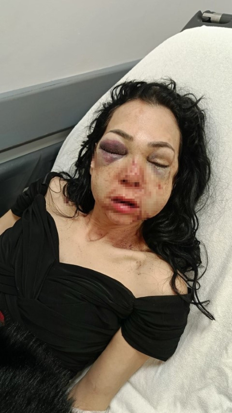 Bir uyarı yüzünden vahşet Anneye feci dayak... Oğlumun gözü önünde bana bunu yaptılar