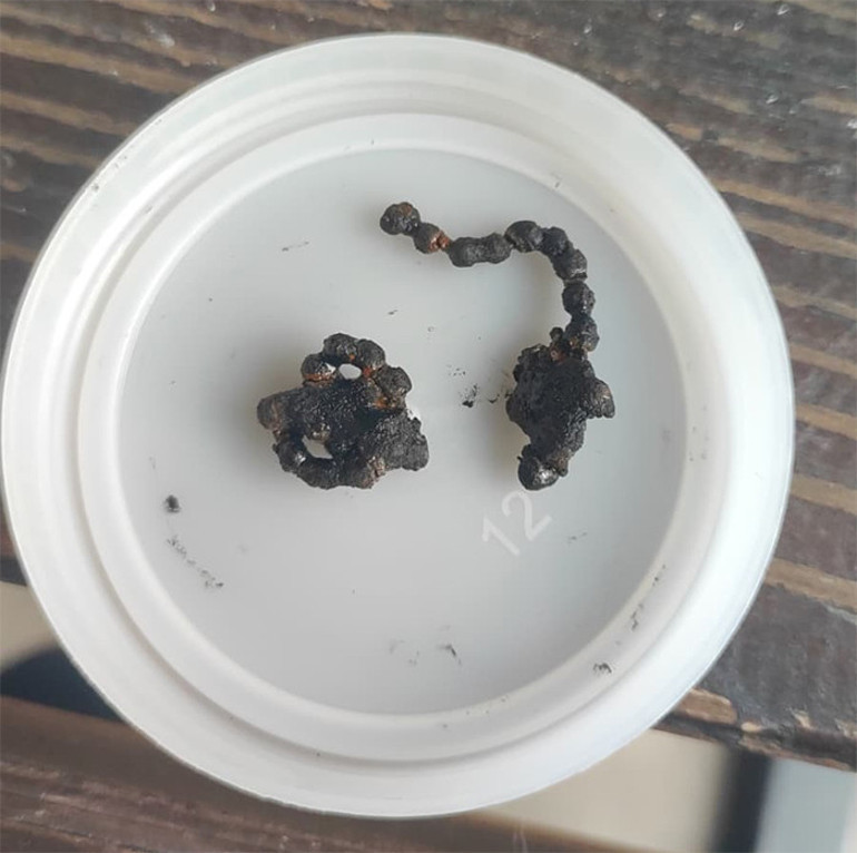  5 yaşındaki Polenin 2 yıl boyunca burnundaymış Bu nasıl gözden kaçabilir