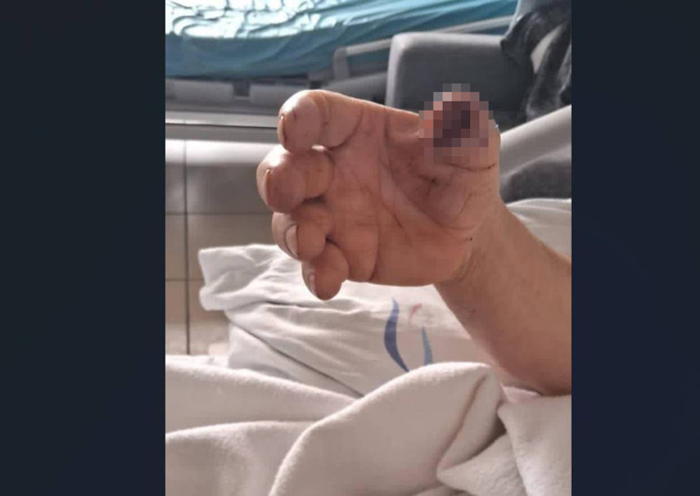  Köpeğin saldırısında koptu, doktorlar yerine dikemedi