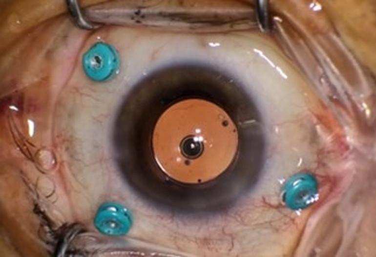 Retina hastalıklarında vitreoretinal cerrahi (vitrektomi)