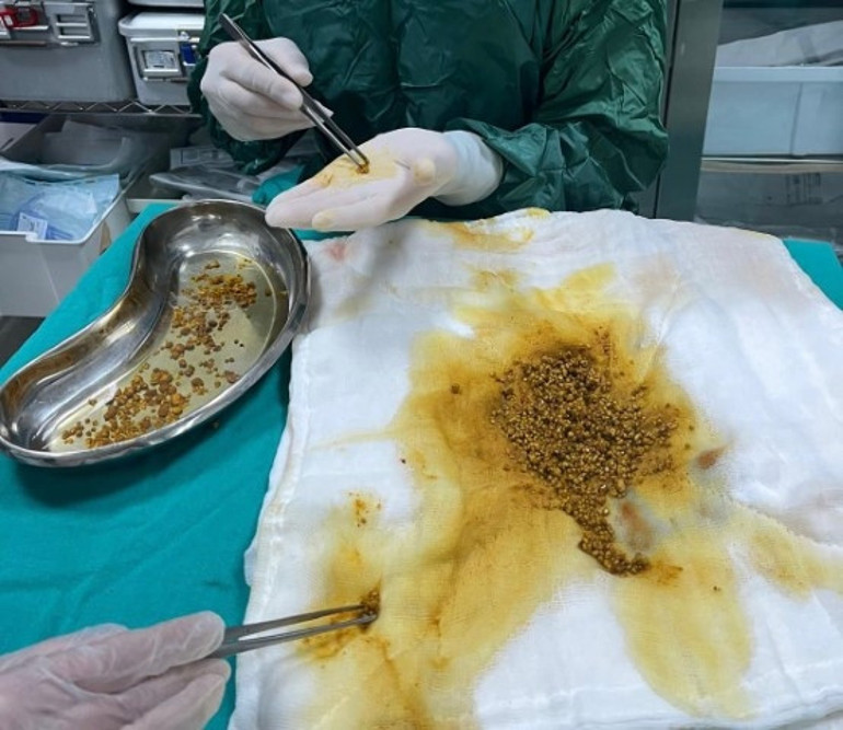 Karın ağrısı şikayeti ile gitti, sebebini öğrenen doktorlar bile şaşkına döndü