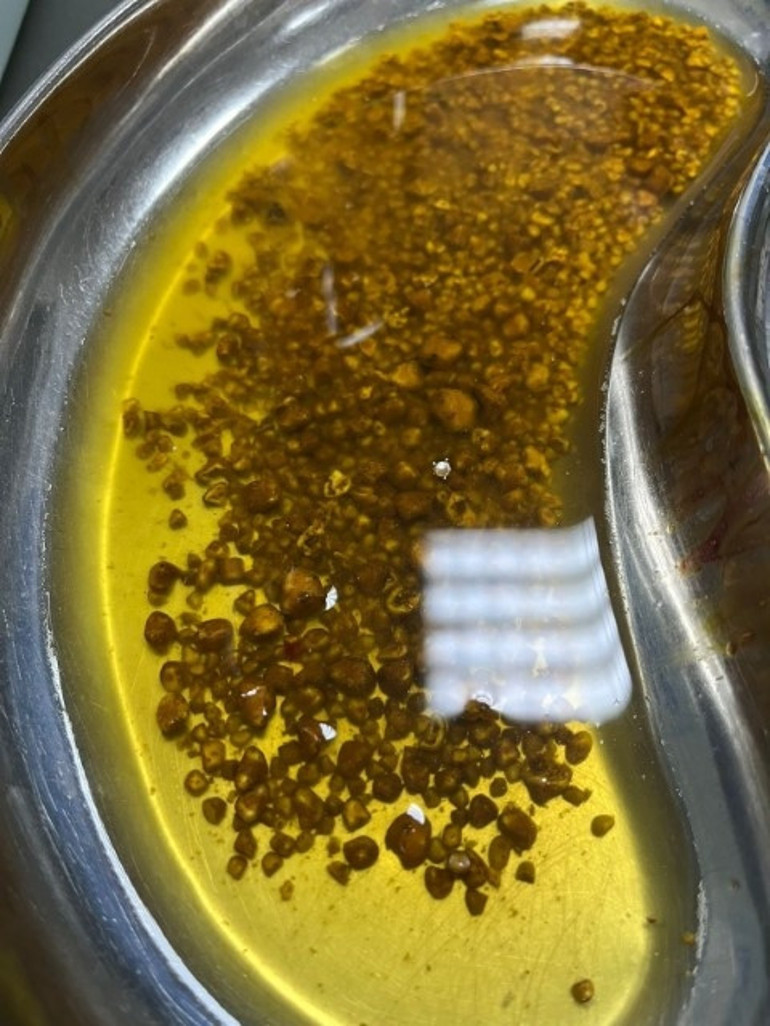 Karın ağrısı şikayeti ile gitti, sebebini öğrenen doktorlar bile şaşkına döndü