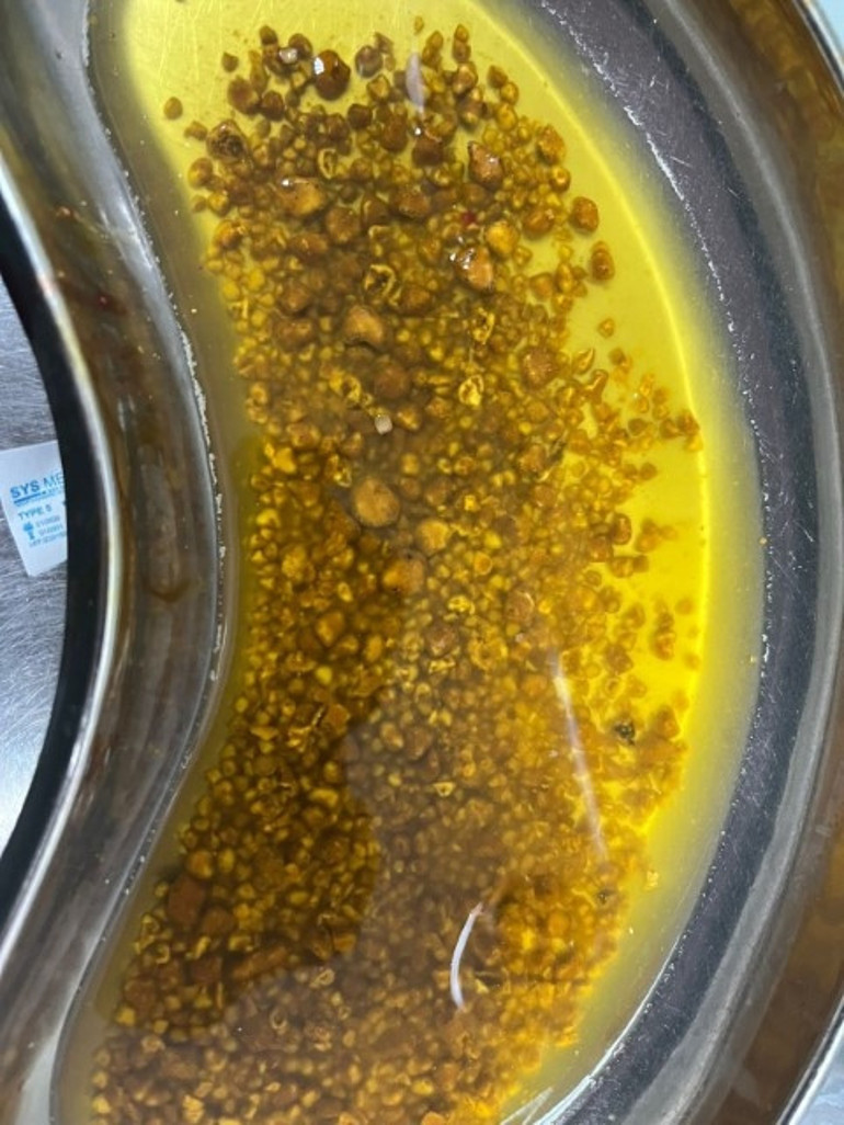 Karın ağrısı şikayeti ile gitti, sebebini öğrenen doktorlar bile şaşkına döndü