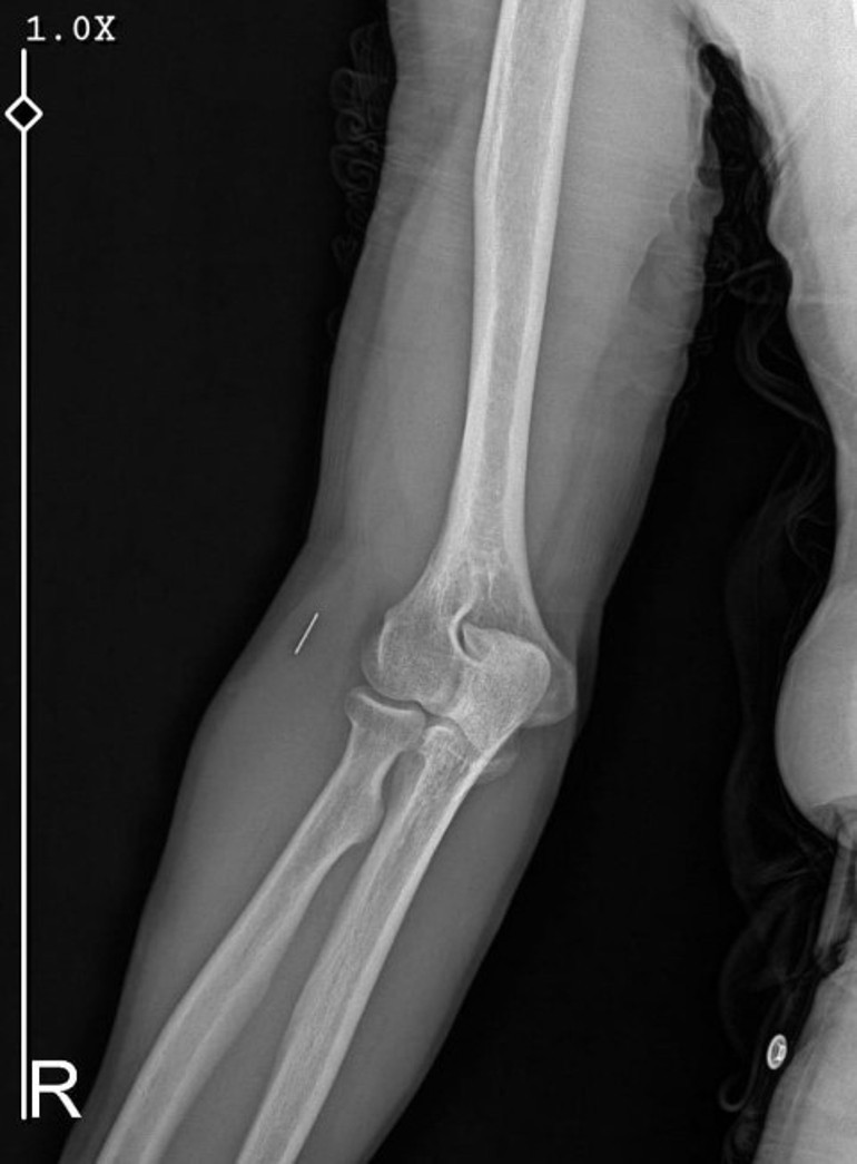  Parmağı alındı, işinden oldu | Elinden koluna doğru ilerlemiş