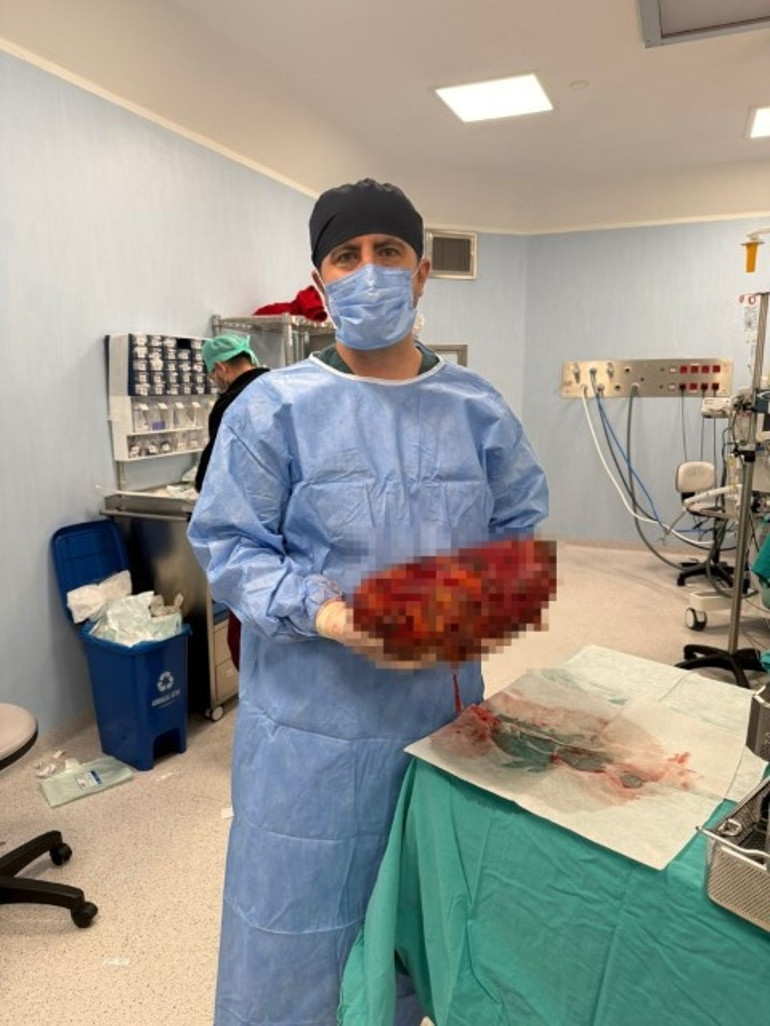 Ağrı şikayeti ile gitti, varılan teşhis doktorları da hayrete düşürdü | Normalde yarım kilo yoktur, benimki 8 kiloya ulaşmıştı