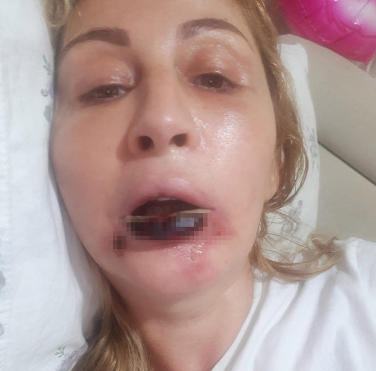 Antalyada estetik kabusu Dudağını kaybeden kadının 7 yıllık hukuk mücadelesi sürüyor