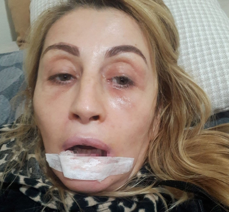 Antalyada estetik kabusu Dudağını kaybeden kadının 7 yıllık hukuk mücadelesi sürüyor