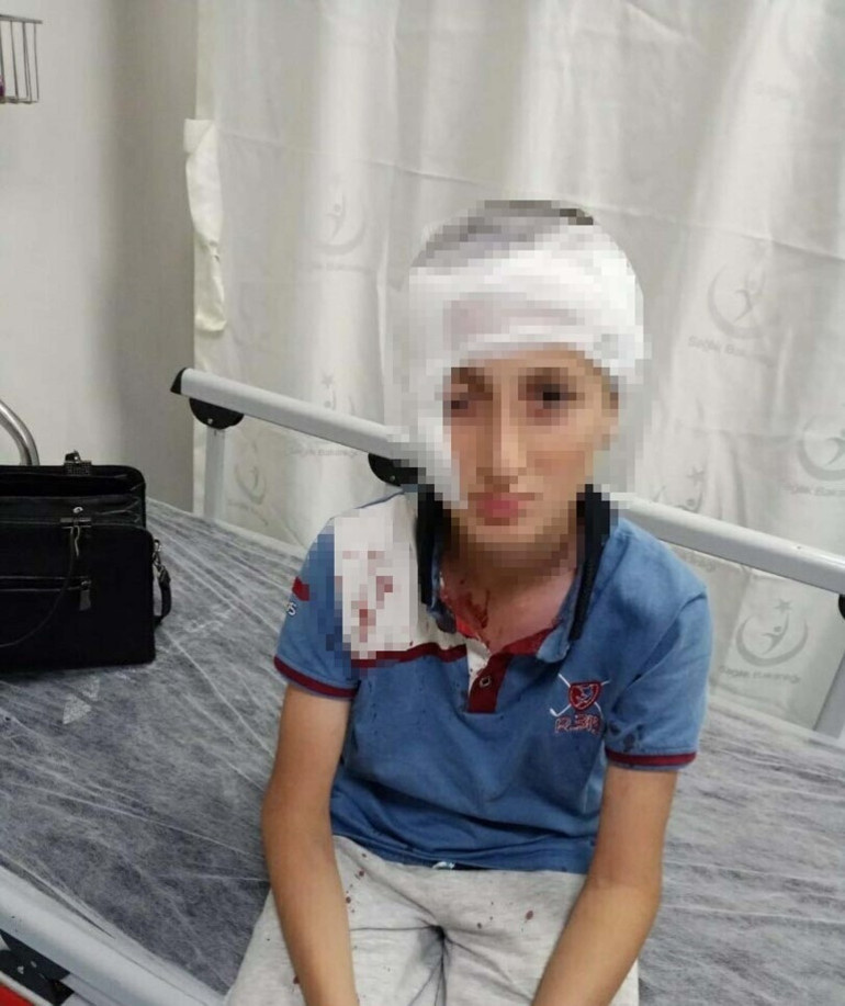 Yaşadığı kabustan sonra çocuğun yüzünde kalıcı izler meydana geldi