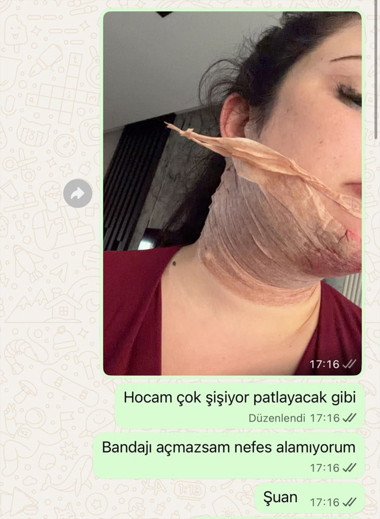 Estetik işlem sonrası kabusu yaşadı Bu benim tamamen hayatla yaşam mücadelem oldu