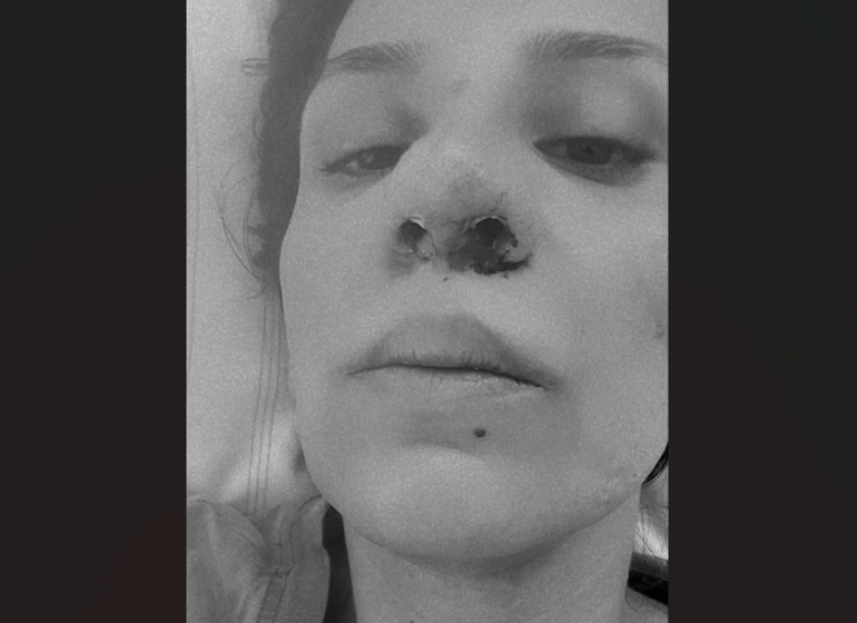 Galata Köprüsünde taciz edip burnunu kırdılar Kabusu yaşayan Aslıhan: Tehdit ediliyorum, ölmek istemiyorum