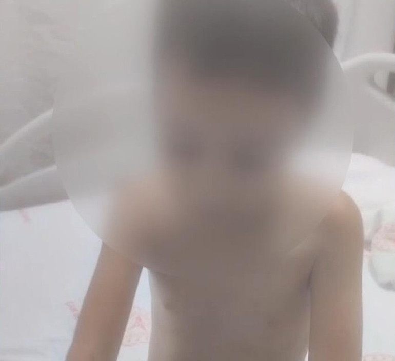 Arnavutköyde akran vahşeti: Arkadaşları kolonya döküp yaktı, 12 yaşındaki çocuk hastanelik oldu