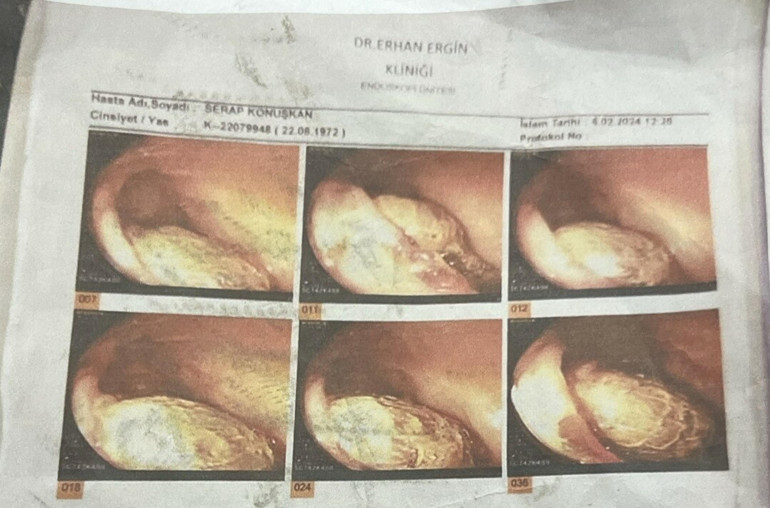 Ameliyatta unutulan gazlı bez bağırsaklarını delmişti: 2 doktora hapis istemiyle dava