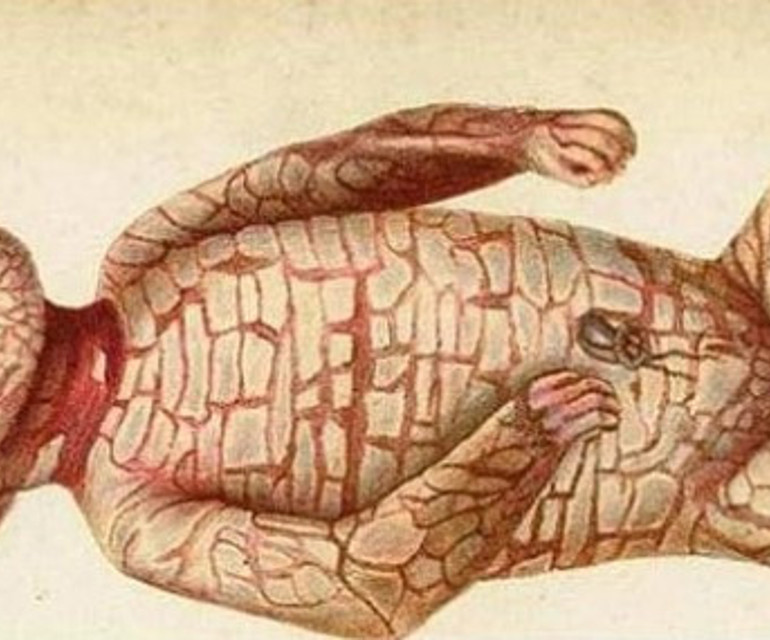 Her gün en az 3 saat banyo yapmak zorunda... 4 yaşındaki Annanın hikayesi... Her gün en az 3 saat banyo yapmak zorunda... 4 yaşındaki Annanın hikayesi...