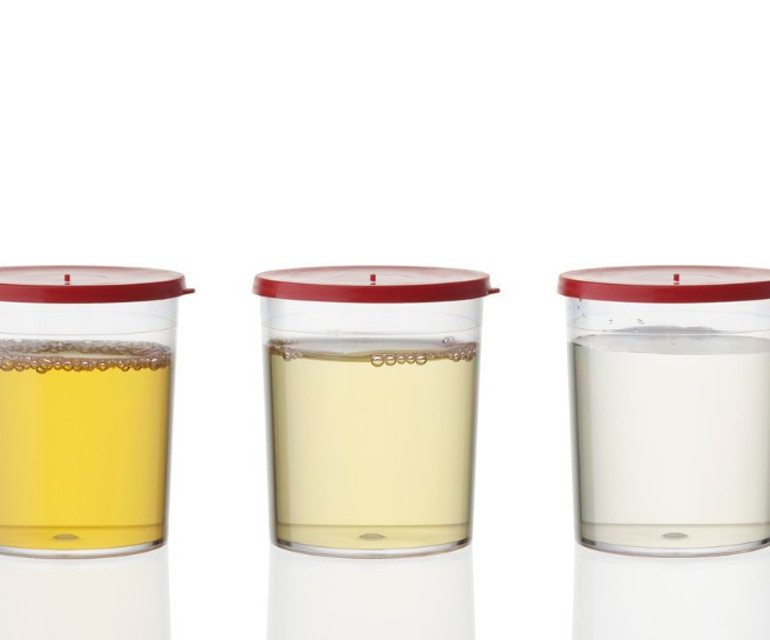 İDRAR RENGİ YETERLİ SU İÇİP İÇMEDİĞİNİZİ SÖYLER