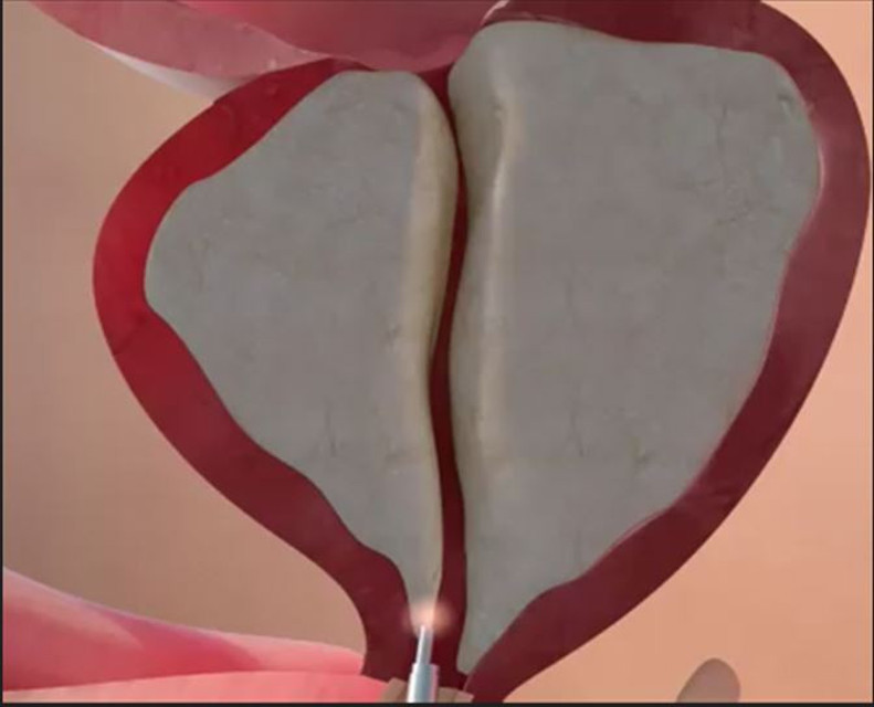 Erkeklerin kâbusu prostat tedavisinde altın yöntem: HoLEP