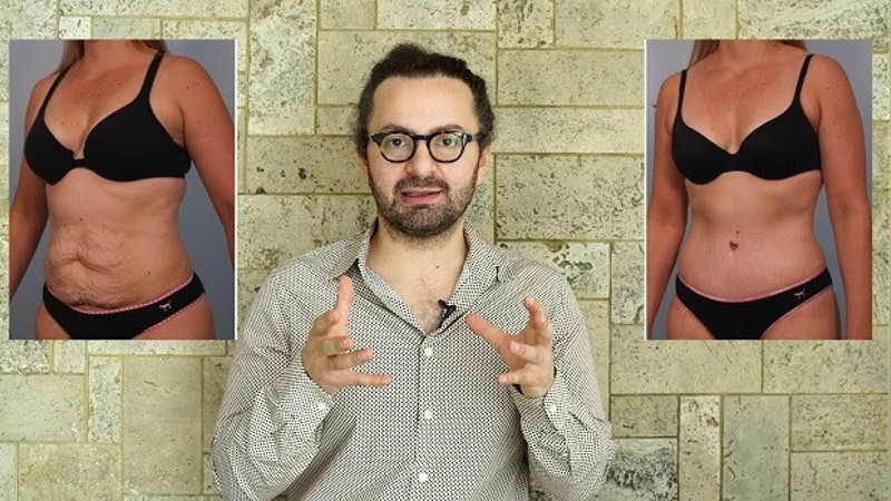 Karın germe ameliyatı | Doktor Bu Ne?