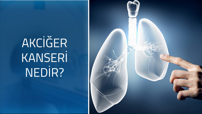 Akciğer kanserinin belirtileri nelerdir? Nasıl bir hastalıktır?