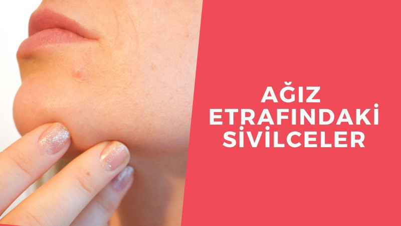 Ağız etrafı sivilceleri nasıl yok edilir?