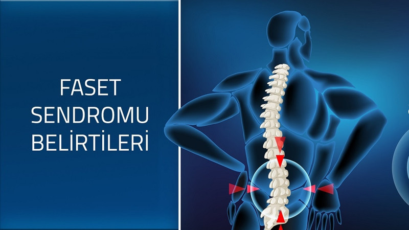 Faset sendromu belirtileri ve tedavisi