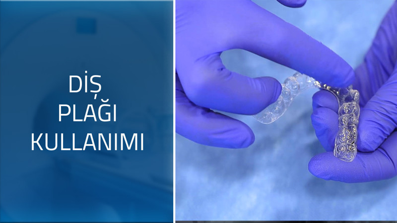 Şeffaf plakların kullanım süresi nedir? 