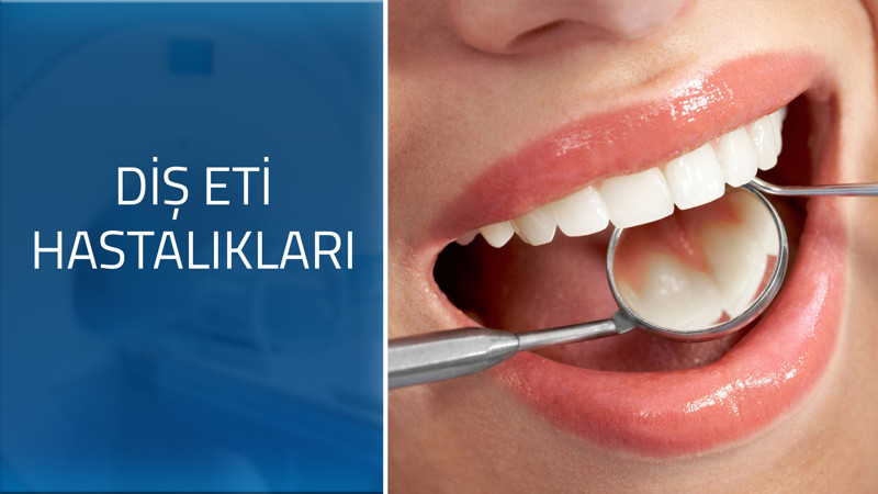 Diş eti hastalıklarının belirtileri nelerdir?