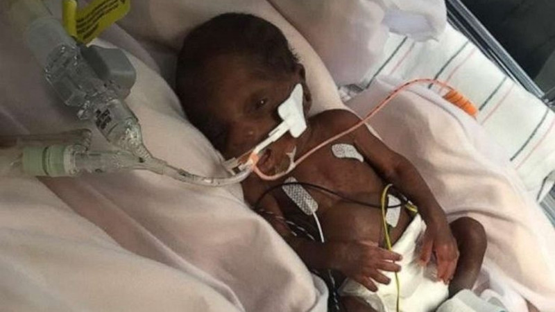 ABD’de 450 gram doğan prematüre bebeğe tedaviden mezuniyet sertifikası