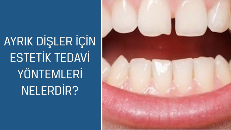 Diş Hekimi ve Protez Uzmanı Dr. Esma Sönmez cevaplıyor; Ayrık dişler için estetik tedavi yöntemleri nelerdir?