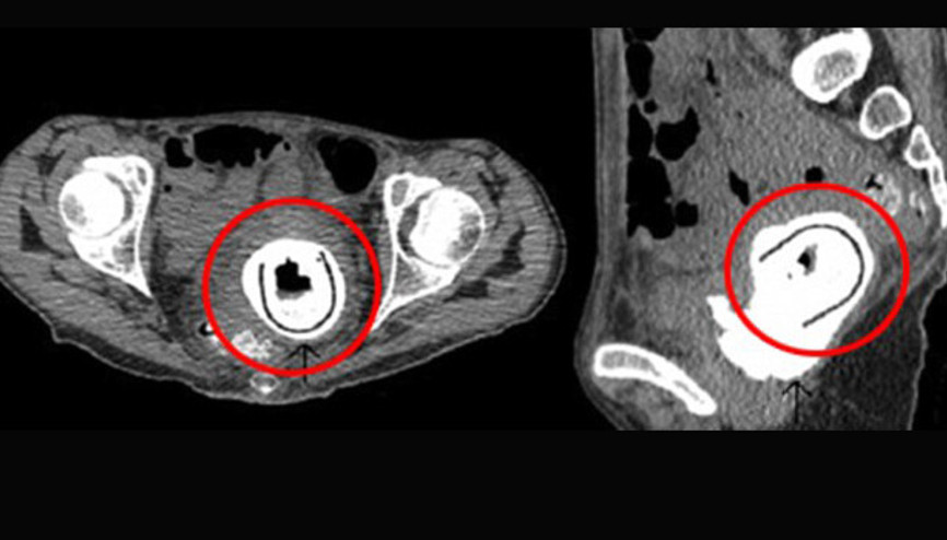Vajinasında 11 santimetrelik seks oyuncağı bulundu Vajinasında 11 santimetrelik seks oyuncağı bulundu